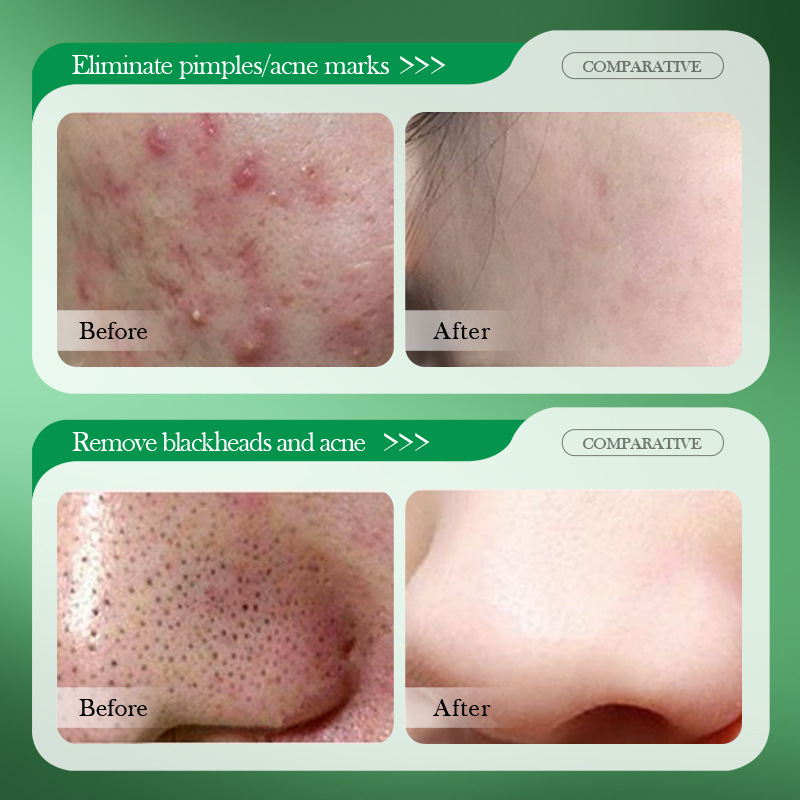 Crème de traitement de l'acné  - Salicylic Acid Blackhead Remover avis et prix